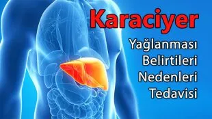 Karaciğer Yağlanmasına Karşı 5 Etkili Önlem!
