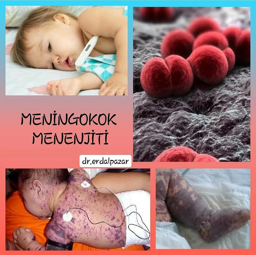 5 Yaş Altı Çocuklar Ve Üniversiteliler İçin Meningokok Riskine Dikkat!